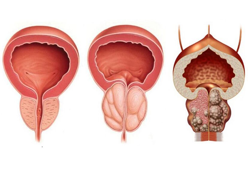 Stadien der Prostatitis und Notwendigkeit einer Behandlung mit Prostavit