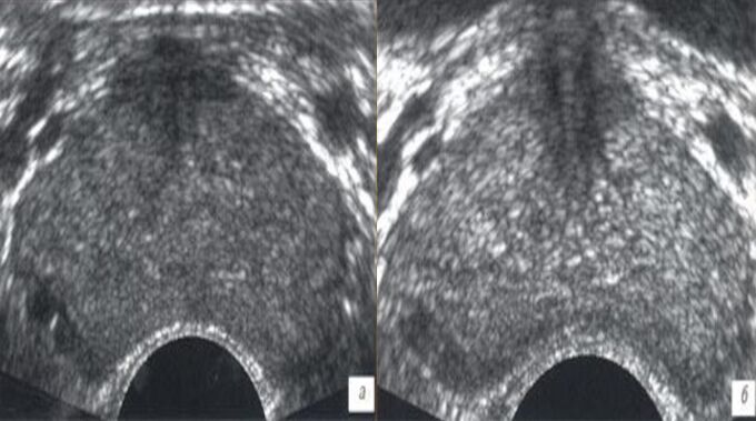 Ultraschall vor und nach der Behandlung mit Prostovit-Tropfen